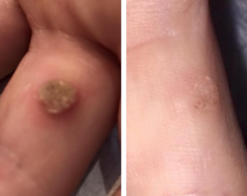 Wart removal before and after result — Fusion Aesthetics